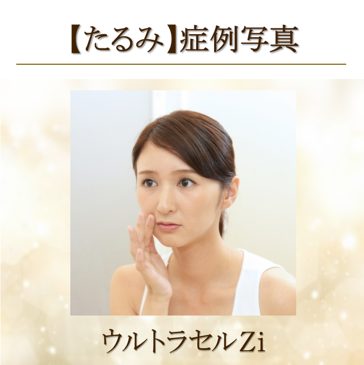 【症例写真】たるみ(ウルトラセルZi)