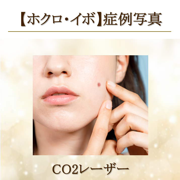 【症例写真】ホクロ・イボ除去(CO2レーザー治療)