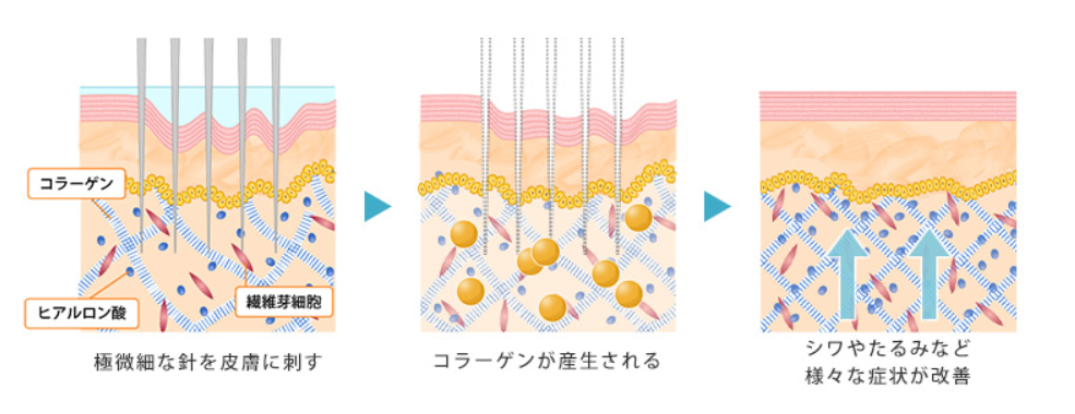 ダーマペンの利点欠点