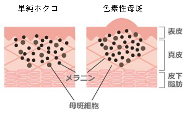 ホクロの種類