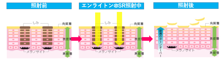 ピコレーザーショット治療