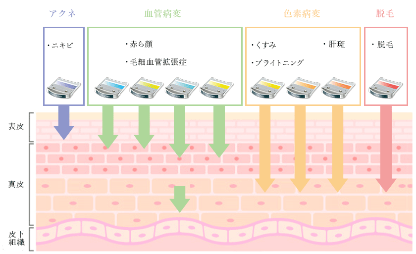 IPL光治療