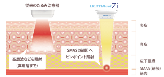ウルトラセルZi