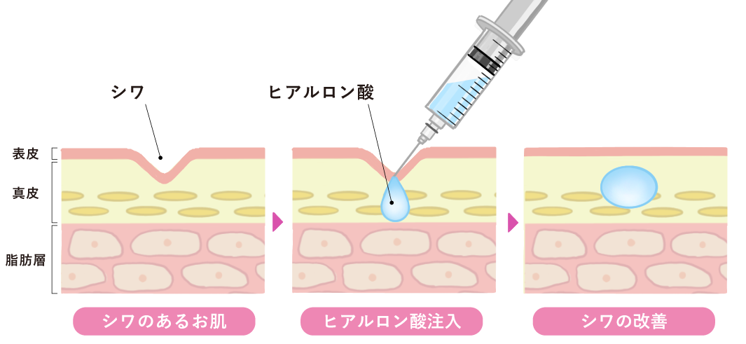 ヒアルロン酸注入