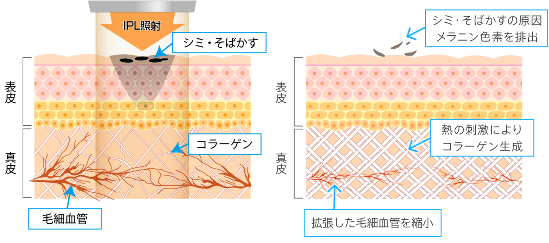 IPL光治療