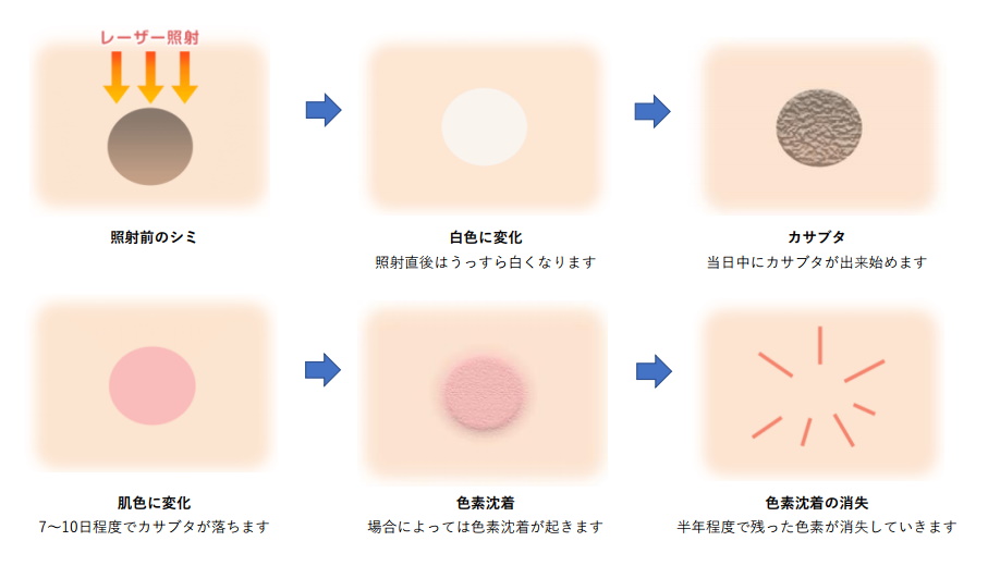 ピコレーザーショット治療