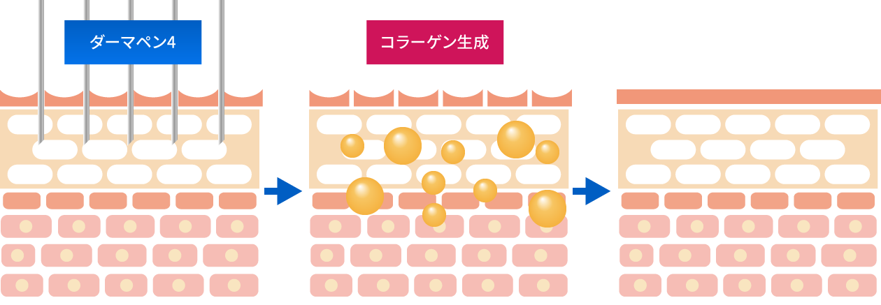 ダーマペン４