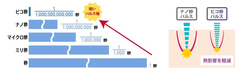 ピコレーザータトゥー除去