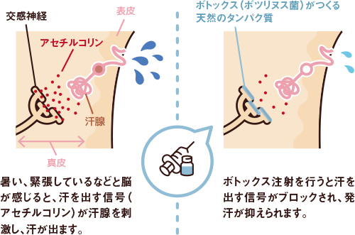 脇ボツリヌストキシン注射