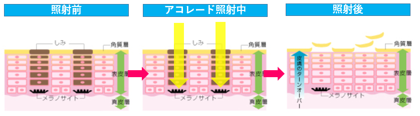 アコレードトーニング治療