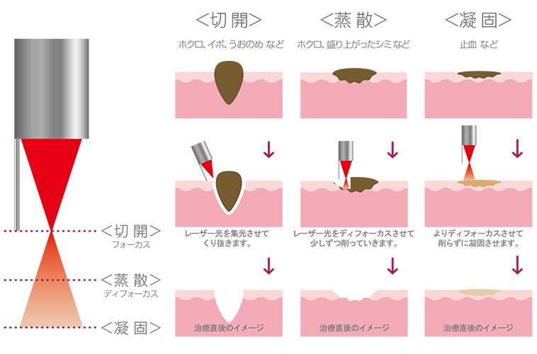 CO2レーザー治療