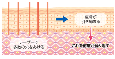 フラクショナルCO2レーザー治療