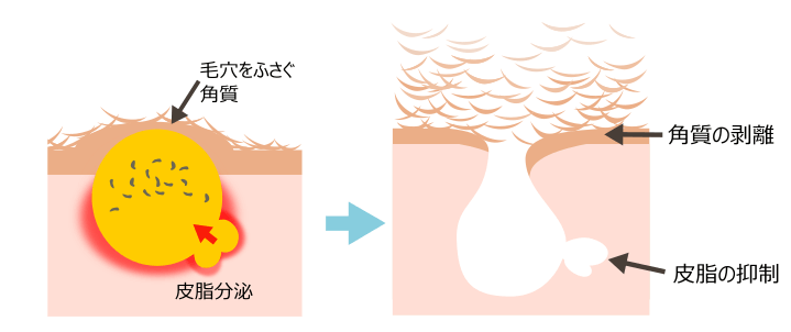 イソトレチノイン