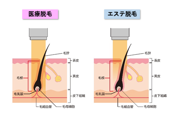 子供医療レーザー脱毛