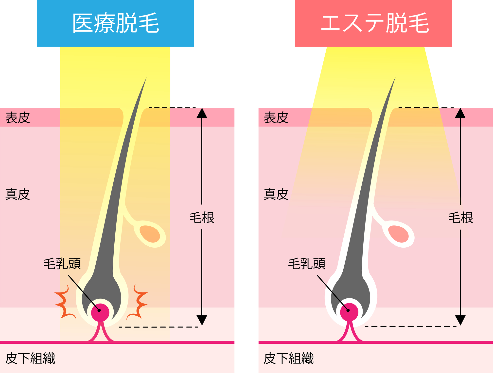 腕・足 医療レーザー脱毛