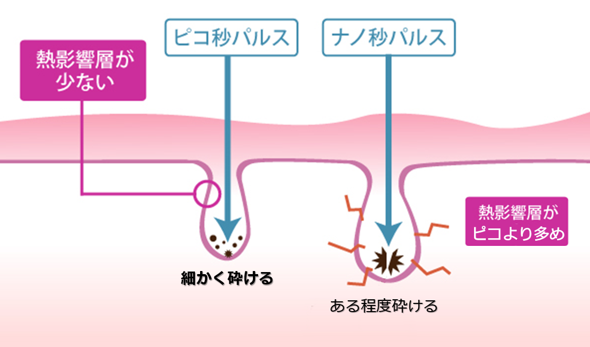 ピコレーザーショット治療