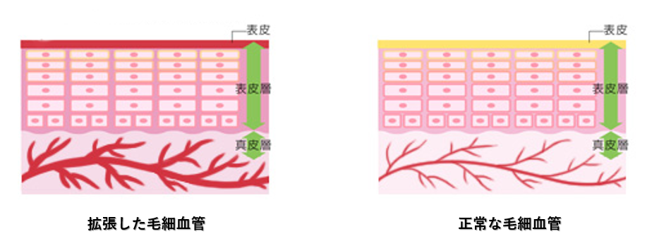 赤ら顔治療