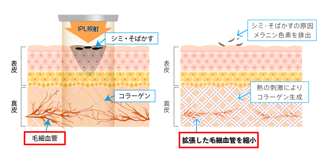 赤ら顔治療